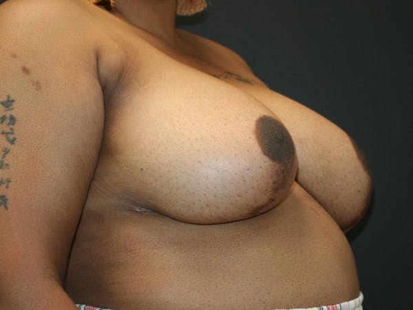 Breast Reduction Before & After Gallery - Patient 63629079 - Image 5
