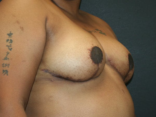 Breast Reduction Before & After Gallery - Patient 63629079 - Image 6
