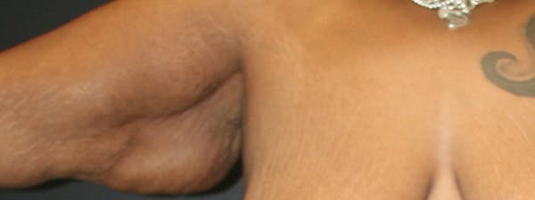 Brachioplasty Before & After Gallery - Patient 63629055 - Image 3