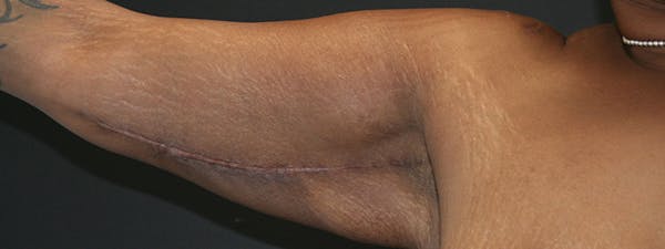 Brachioplasty Before & After Gallery - Patient 63629055 - Image 4