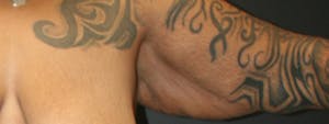 Before and after brachioplasty