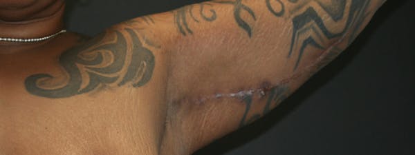 Brachioplasty Before & After Gallery - Patient 63629055 - Image 2