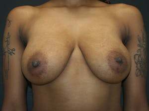 Before and after breast reduction surgery
