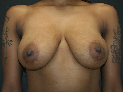 Breast Reduction Gallery - Patient 74769085 - Image 1
