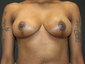 Before and after breast reduction surgery