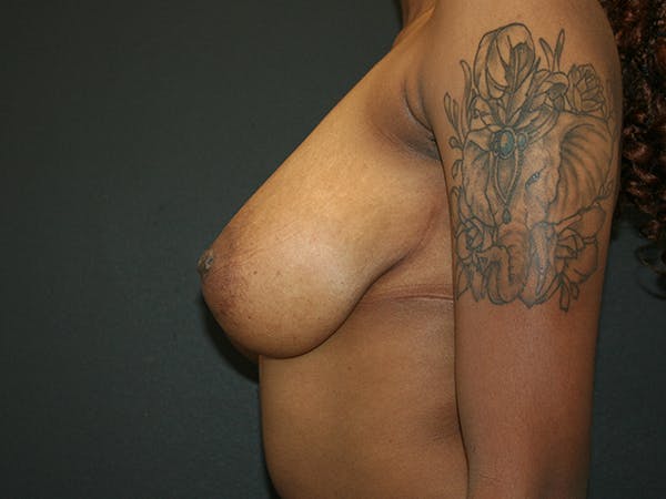 Breast Reduction Before & After Gallery - Patient 74769085 - Image 5