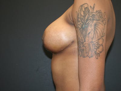 Breast Reduction Before & After Gallery - Patient 74769085 - Image 6