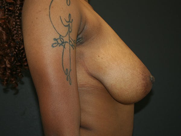 Breast Reduction Before & After Gallery - Patient 74769085 - Image 9