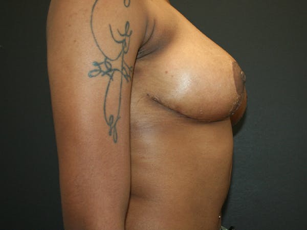 Breast Reduction Before & After Gallery - Patient 74769085 - Image 10