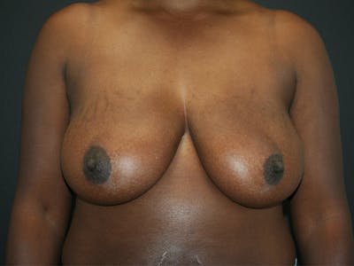 Breast Reduction Before & After Gallery - Patient 98950892 - Image 1