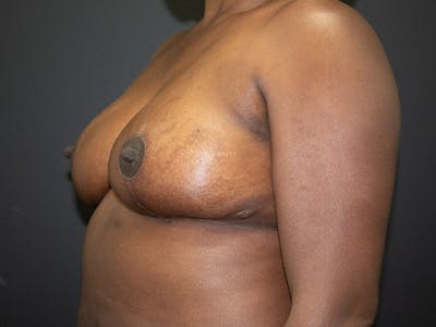 Breast Reduction Before & After Gallery - Patient 98950892 - Image 4