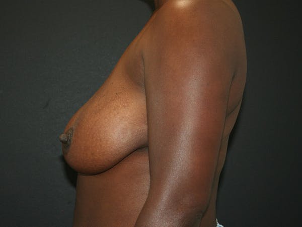 Breast Reduction Before & After Gallery - Patient 98950892 - Image 5