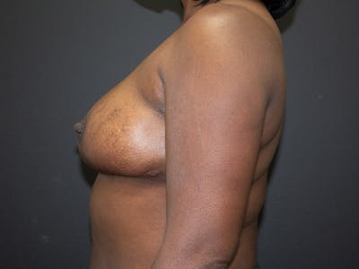 Breast Reduction Before & After Gallery - Patient 98950892 - Image 6
