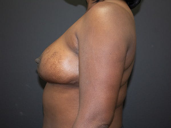 Breast Reduction Before & After Gallery - Patient 98950892 - Image 6