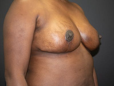 Breast Reduction Before & After Gallery - Patient 98950892 - Image 8