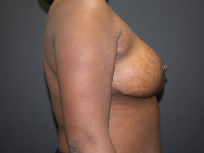 Breast Reduction Before & After Gallery - Patient 98950892 - Image 10