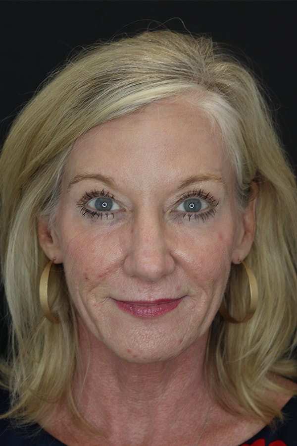 Facelift & Necklift Before & After Gallery - Patient 105177110 - Image 1