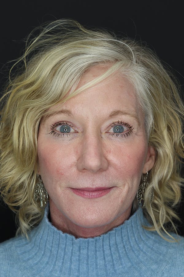 Eyelid Surgery Before & After Gallery - Patient 105177152 - Image 2