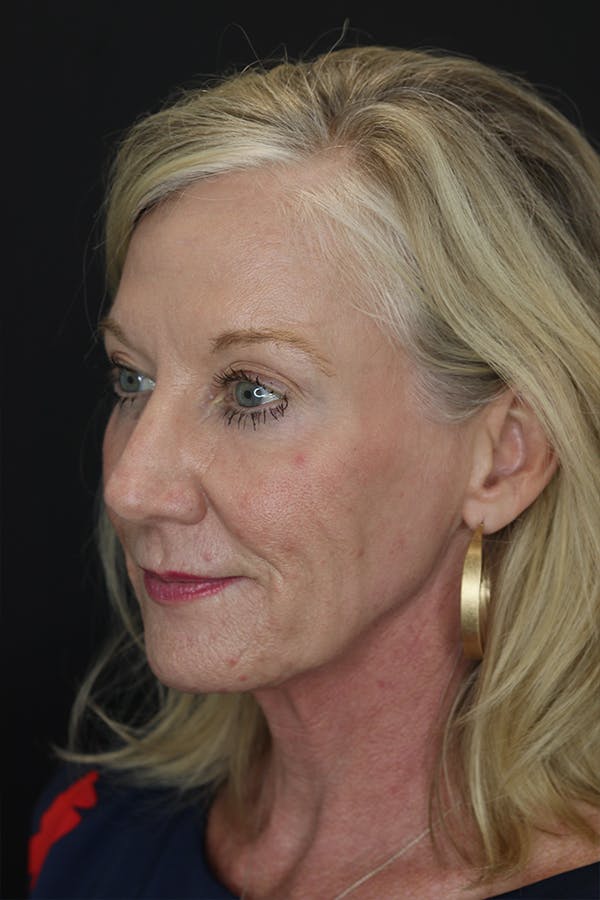 Eyelid Surgery Before & After Gallery - Patient 105177152 - Image 3