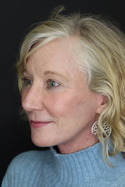 Eyelid Surgery Before & After Gallery - Patient 105177152 - Image 4