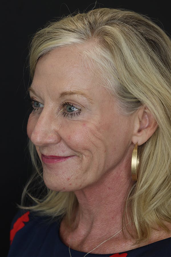 Eyelid Surgery Before & After Gallery - Patient 105177152 - Image 5