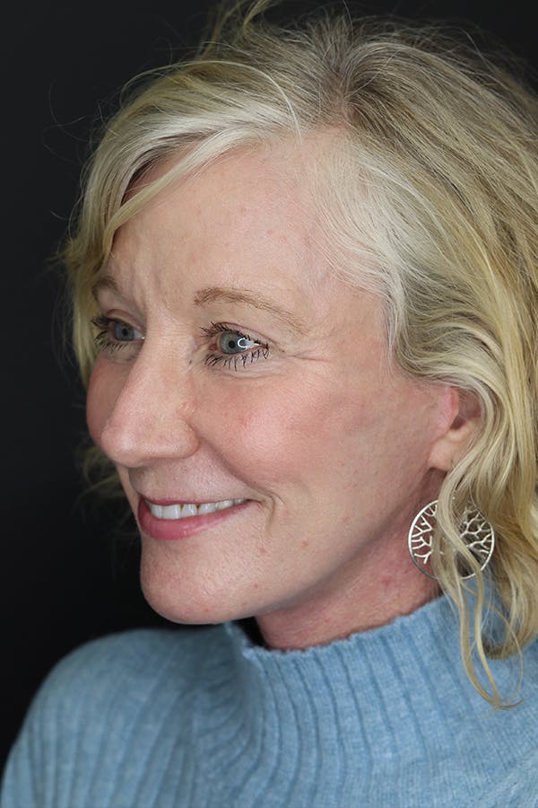 Eyelid Surgery Before & After Gallery - Patient 105177152 - Image 6