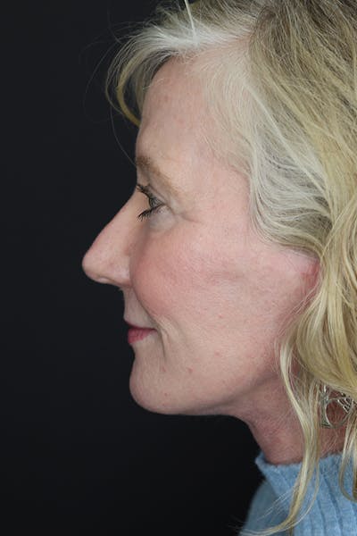 Eyelid Surgery Before & After Gallery - Patient 105177152 - Image 8