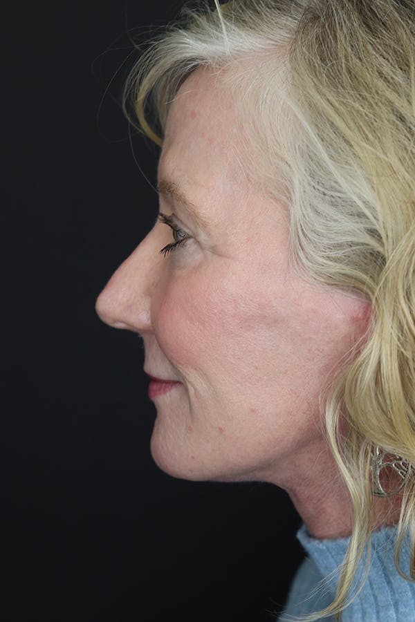 Eyelid Surgery Before & After Gallery - Patient 105177152 - Image 8