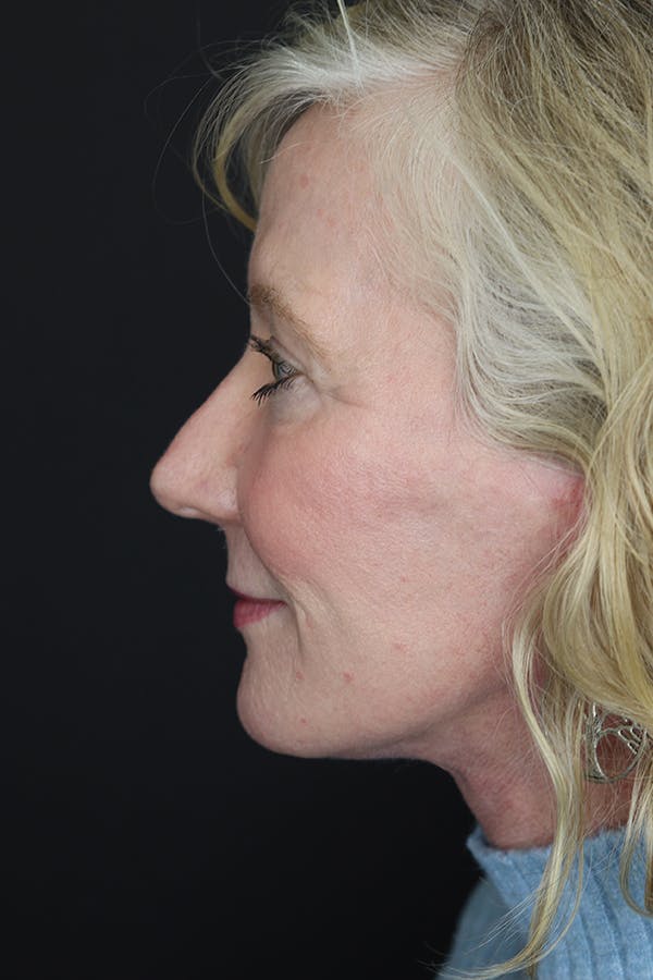 Facelift & Necklift Before & After Gallery - Patient 105177110 - Image 8