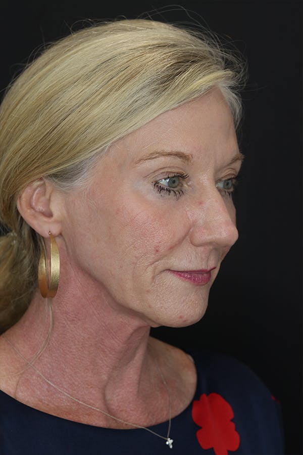 Facelift & Necklift Before & After Gallery - Patient 105177110 - Image 9