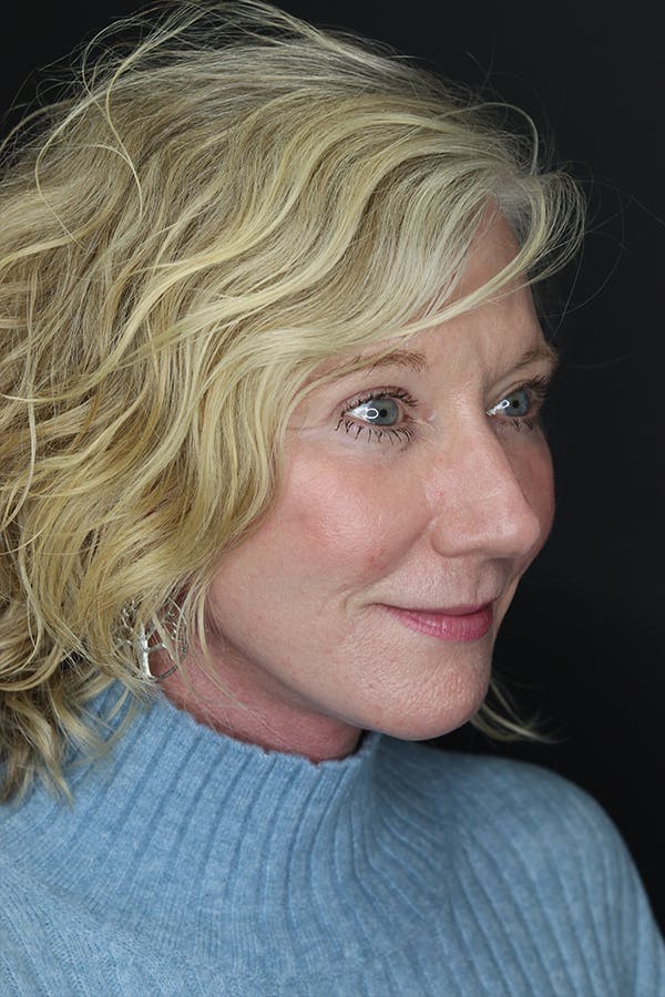 Eyelid Surgery Before & After Gallery - Patient 105177152 - Image 10