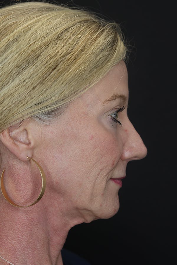 Eyelid Surgery Before & After Gallery - Patient 105177152 - Image 11
