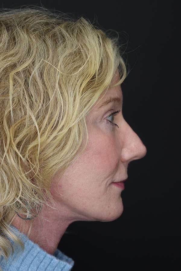 Facelift & Necklift Before & After Gallery - Patient 105177110 - Image 12