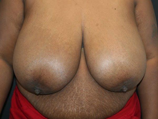 Breast Reduction Gallery - Patient 107315425 - Image 1