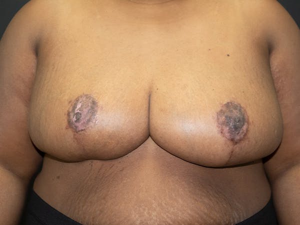 Breast Reduction Before & After Gallery - Patient 107315425 - Image 2