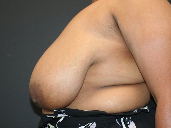 Breast Reduction Before & After Gallery - Patient 107315424 - Image 5