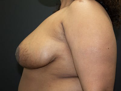 Breast Reduction Before & After Gallery - Patient 107315424 - Image 6