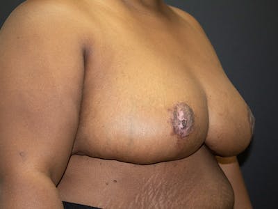 Breast Reduction Gallery - Patient 107315425 - Image 4