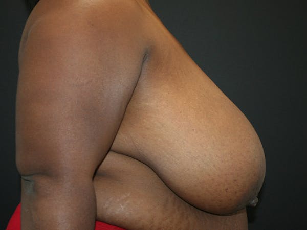 Breast Reduction Gallery - Patient 107315425 - Image 5