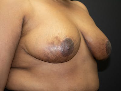 Breast Reduction Before & After Gallery - Patient 107315424 - Image 8