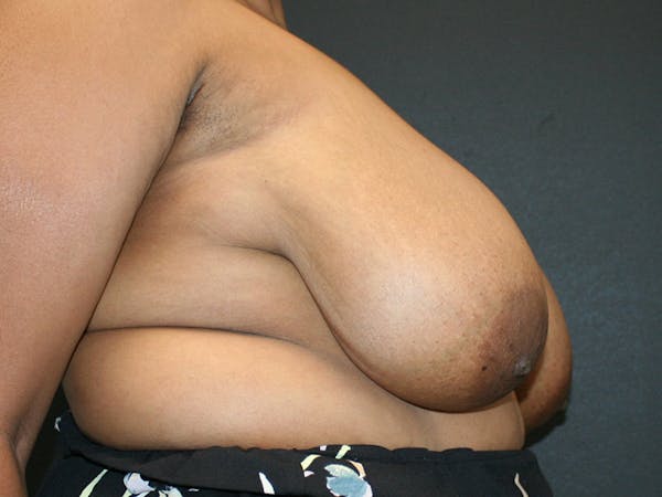Breast Reduction Before & After Gallery - Patient 107315424 - Image 9