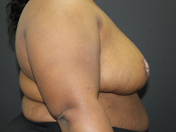 Breast Reduction Before & After Gallery - Patient 107315425 - Image 6