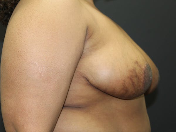 Breast Reduction Gallery - Patient 107315424 - Image 10