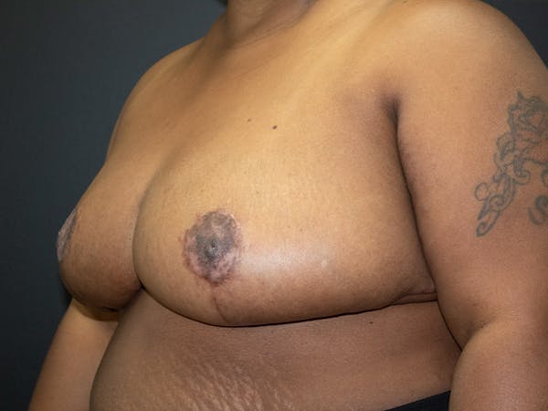 Breast Reduction Gallery - Patient 107315425 - Image 8