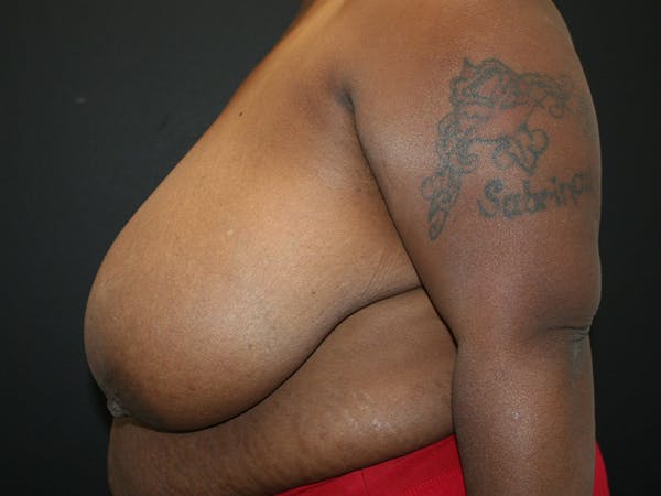 Breast Reduction Before & After Gallery - Patient 107315425 - Image 9