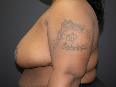 Breast Reduction Before & After Gallery - Patient 107315425 - Image 10