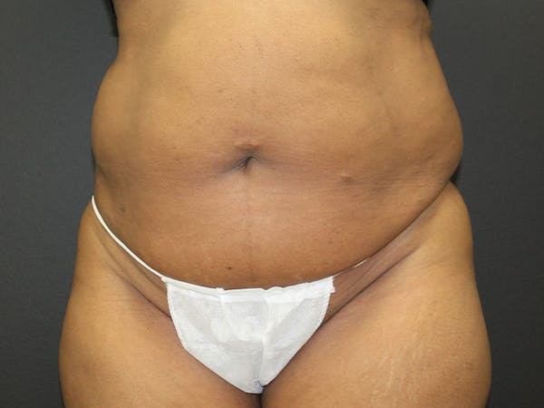 Abdominoplasty Before & After Gallery - Patient 107315659 - Image 1