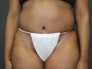 Before and after tummy tuck surgery