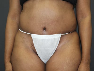 Abdominoplasty Before & After Gallery - Patient 107315659 - Image 2