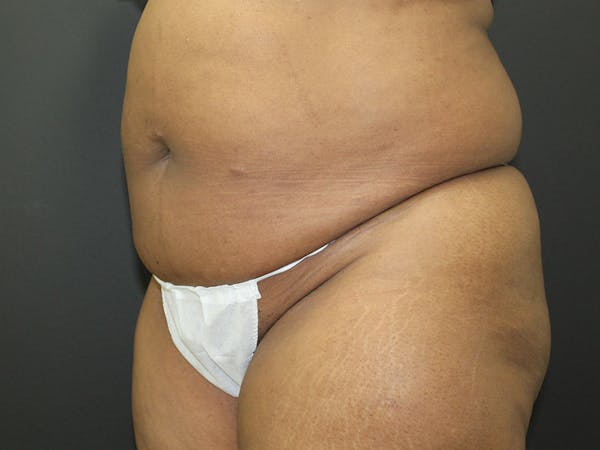 Abdominoplasty Before & After Gallery - Patient 107315659 - Image 3